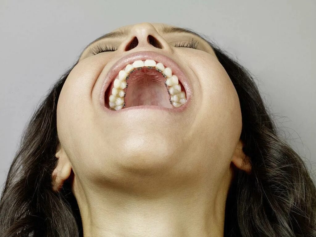 Нижнее небо во рту фото Cost of Lingual Braces Treatment in India