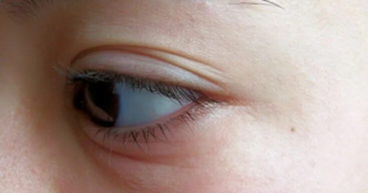 Нижнее веко фото Crying is one of the most common causes of puffy, swollen eyes. While prevention