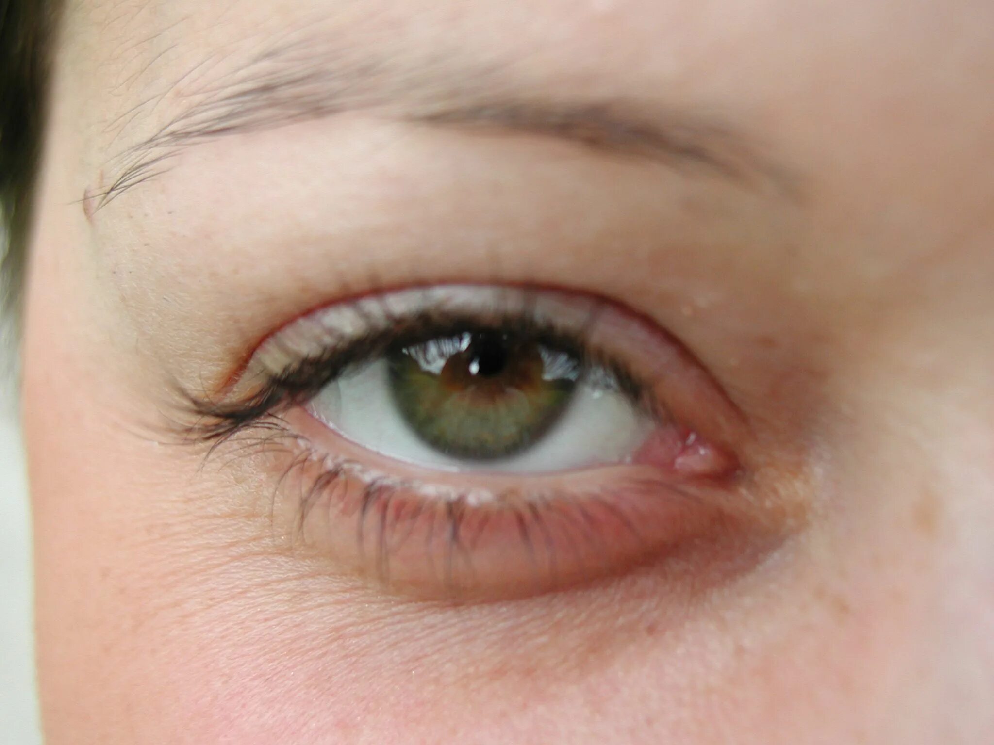 Нижнее веко фото free photos people - AT Yahoo! Search Results Photos of eyes, Puffy eyes, Dry ey