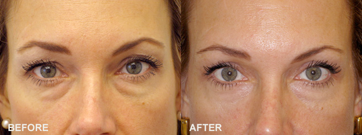 Нижнее веко фото juvederm eyes before after photos Eyelid surgery, Double eyelid, Cosmetic surger