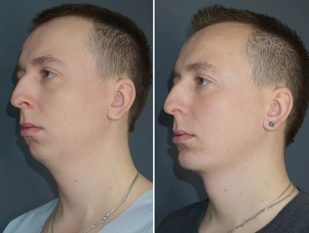 Нижней челюсти фото до и после Лучший пластический хирург в своем деле Шемонаева Ольга Михайловна топ пластичес