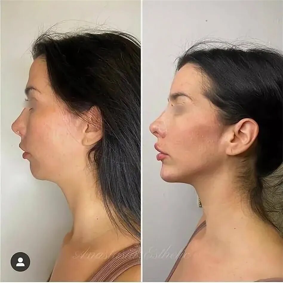 Нижней челюсти фото до и после Top 10 plastic surgery before and after face ideas and inspiration