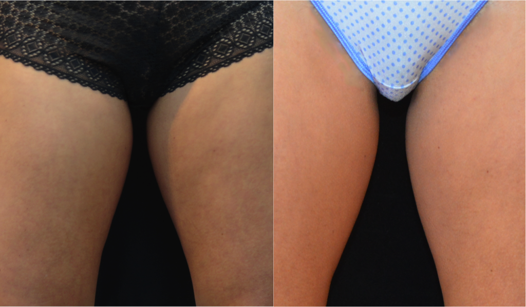 Нижние половые губы фото Thigh-Gap-after-CS-copy Plastic Surgeon San Francisco Pacific Heights Plastic Su