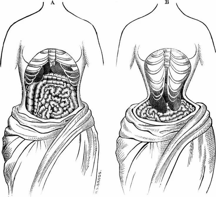 Нижние ребра фото Here's How Corsets Deformed The Skeletons Of Victorian Women Victorian corset, V