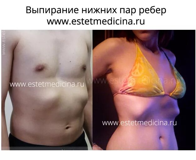 Нижние ребра фото Выпирание ребер (протрузия реберных дуг)