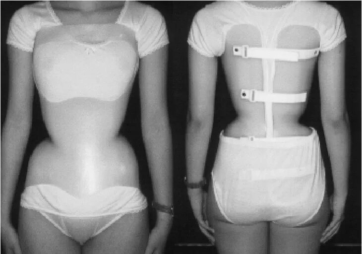 Нижние ребра фото Figure 4 from Adolescent Idiopathic Scoliosis ( AIS ) : An Overview of the Etiol