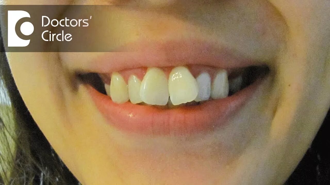 Нижние резцы фото How to treat big front teeth & what is the cost of the treatment? - Dr. Mohammed