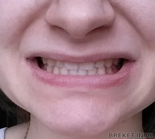 Нижние зубы фото Hello! I'm a new member in the group and don't understand much about orthodontic