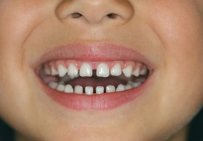 Нижние зубы фото по номерам Are spaces between baby teeth normal? - Non-Extraction Orthodontics