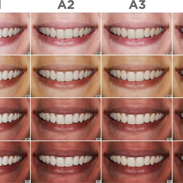Нижние зубы фото по номерам A2 veneers - Get custom fittings and a fresh look in just 2 to 3 visits!