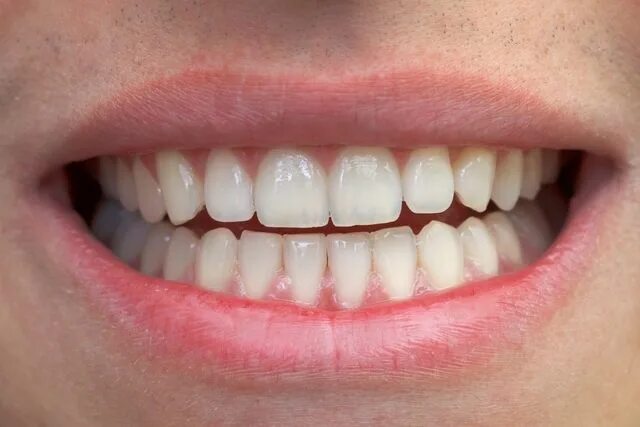 Нижние зубы фото по номерам Solução caseira para remover tártaro e clarear os dentes naturalmente Branqueame