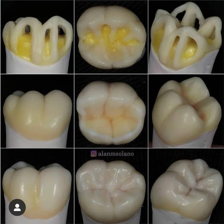 Нижний 6 зуб фото Wax up Bruxismo dental, Restauración dental, Estetica dental Restauración dental