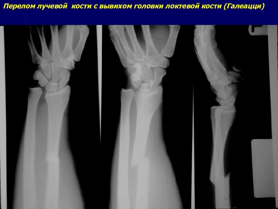Нижний конец лучевой кости фото Перелом нижнего конца лучевой кости закрытый
