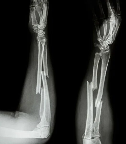 Нижний конец лучевой кости фото Fracture of the ulnar and radial cat. The patient, 24 years old, fell from the 3