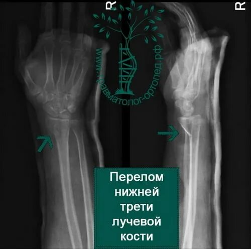 Нижний конец лучевой кости фото Картинки ДИСТАЛЬНЫЙ ПЕРЕЛОМ ЛУЧЕВОЙ