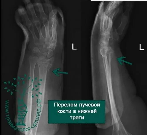 Нижний конец лучевой кости фото Перелом нижней трети локтевой кости - найдено 88 картинок