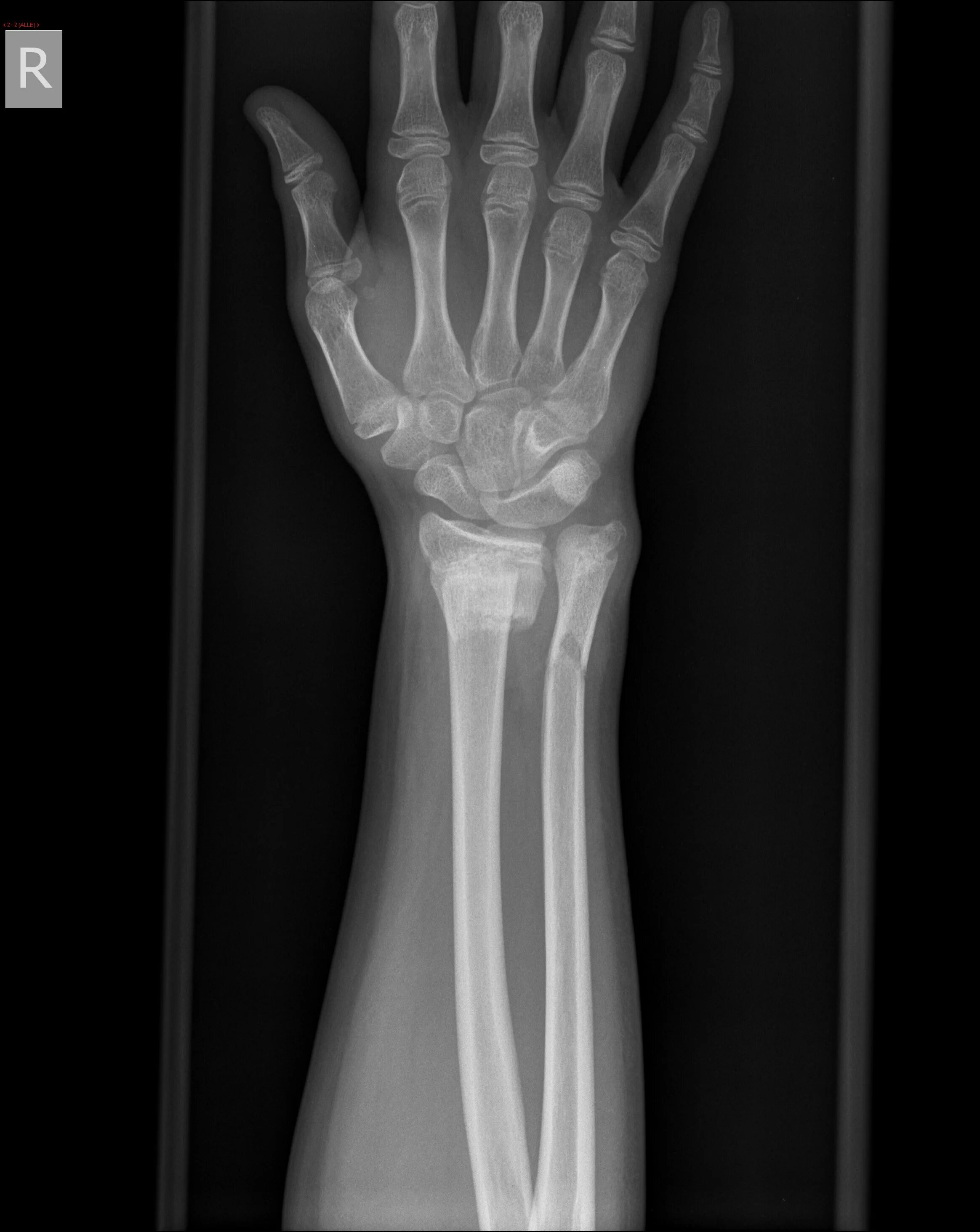 Нижний конец лучевой кости на руке фото Image Radiopaedia.org
