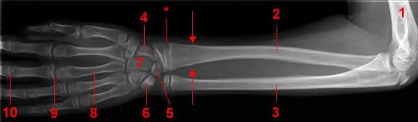 Нижний конец лучевой кости на руке фото Forearm X-ray - W-Radiology