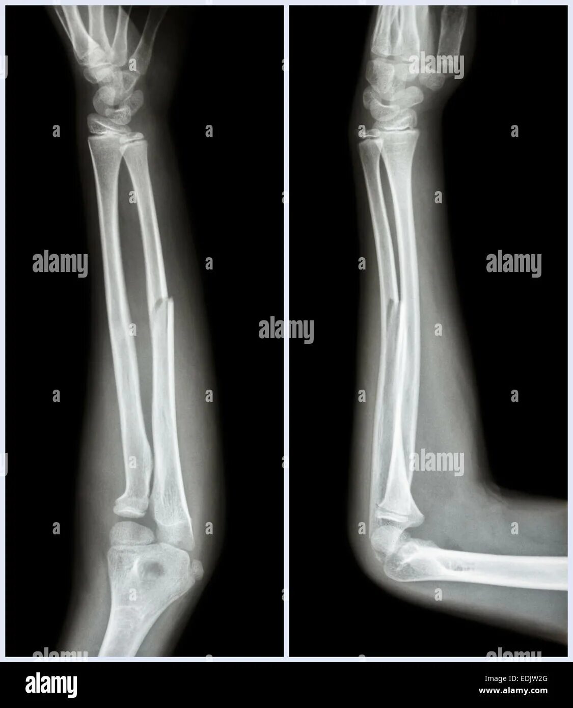 Нижний конец лучевой кости на руке фото Fracture shaft of ulnar bone ( forearm bone ) : ( front and side view Stock Phot