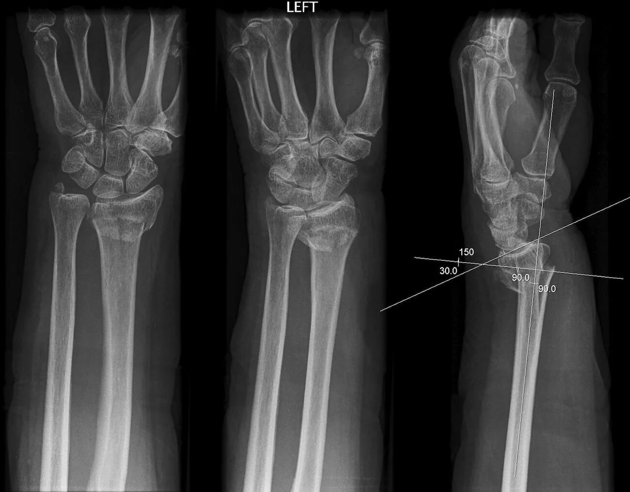 Нижний конец лучевой кости на руке фото Colles Fx fall on outstretched hand. distal radius fx (with the shown angles) of