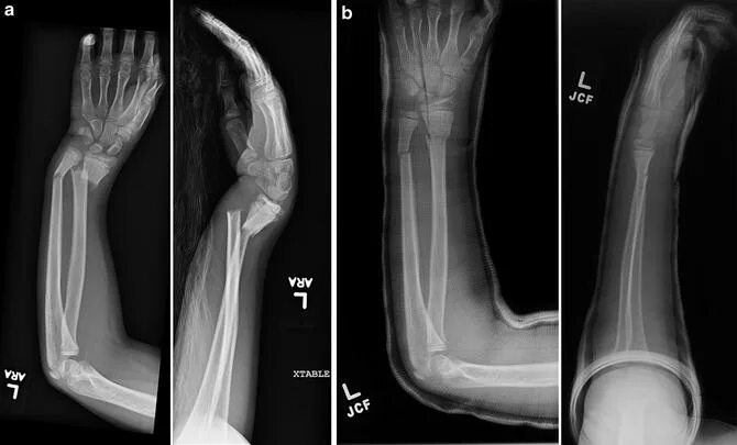 Нижний конец лучевой кости на руке фото Distal Radius Fractures Obgyn Key