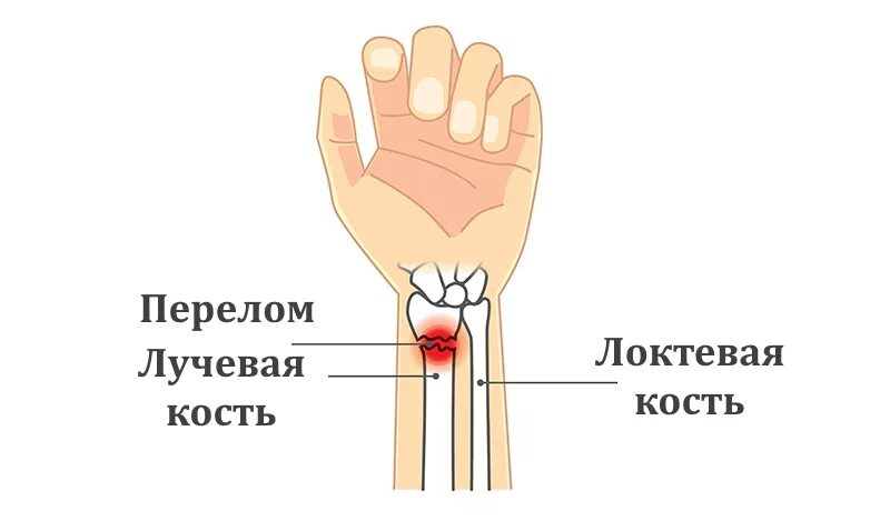 Нижний конец лучевой кости на руке фото Перелом кости руки сроки лечения лучевой