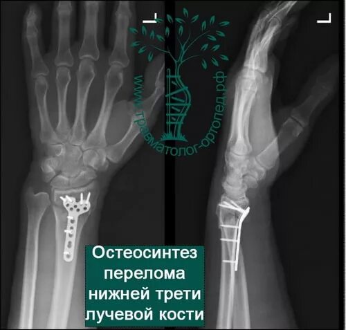 Нижний конец лучевой кости на руке фото Картинки ДИСТАЛЬНЫЙ ПЕРЕЛОМ ЛУЧЕВОЙ