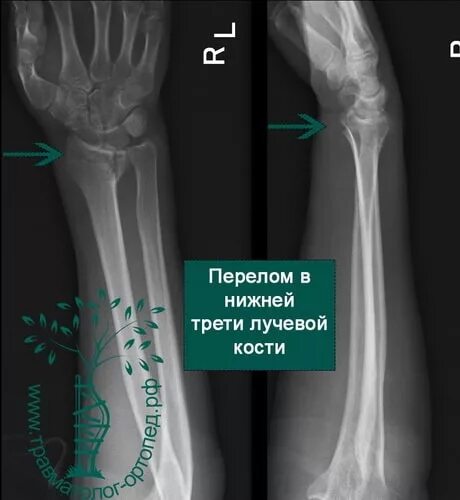 Нижний конец лучевой кости на руке фото Перелом нижнего конца лучевой кости закрытый