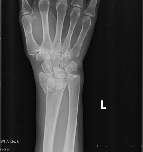 Нижний конец лучевой кости на руке фото Chapter 11: Fractures Flashcards Quizlet