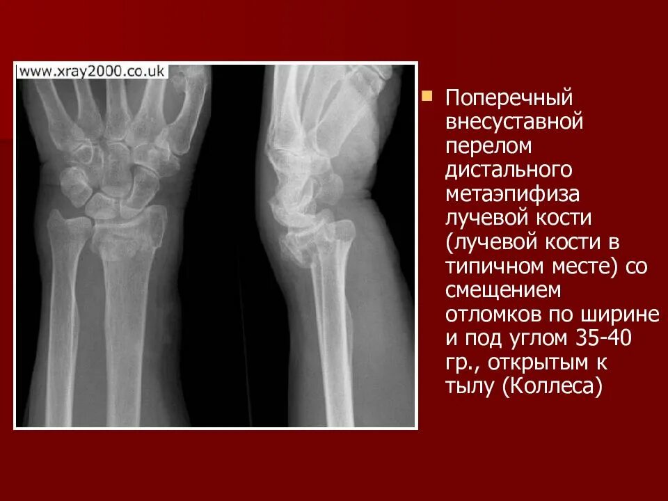 Нижний конец лучевой кости на руке фото 2 лучевые кости: найдено 80 изображений