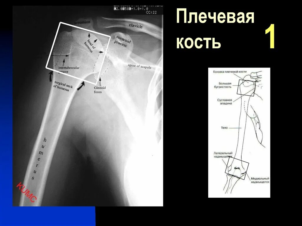 Нижний конец плечевой кости фото Плечевой сустав проекции - найдено 88 фото