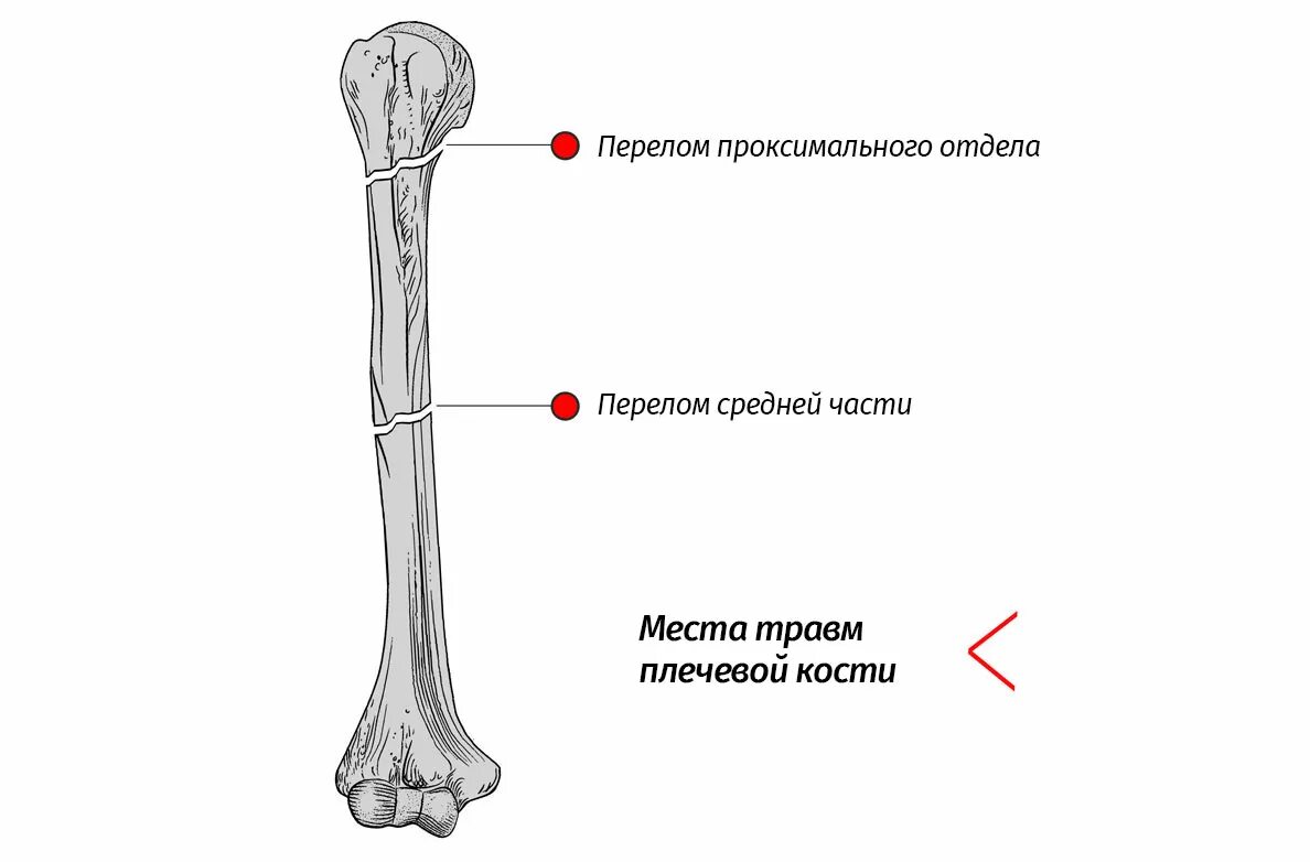 Нижний конец плечевой кости фото Плечевой ортез с 3-мя уровнями стабилизации AM-BX-01