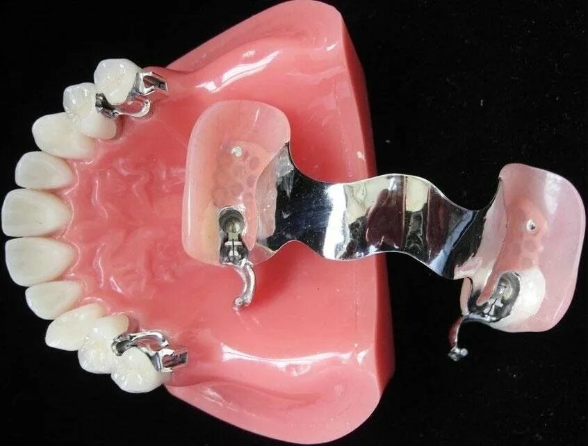 Нижний протез на замках фото Sell Dental Implant Restorations (China Manufacturer) - Personal Care Appliance 