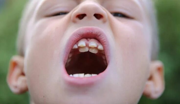 Нижний ряд зубов фото People with hyperdontia have extra, or supernumerary, teeth. Most of these teeth