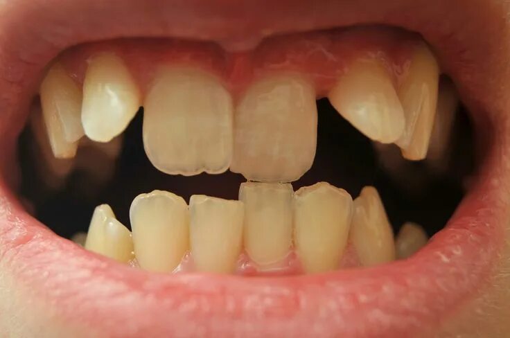 Нижний ряд зубов фото Pin on figure in 2024 Teeth aesthetic, Natural teeth whitening, Crooked teeth