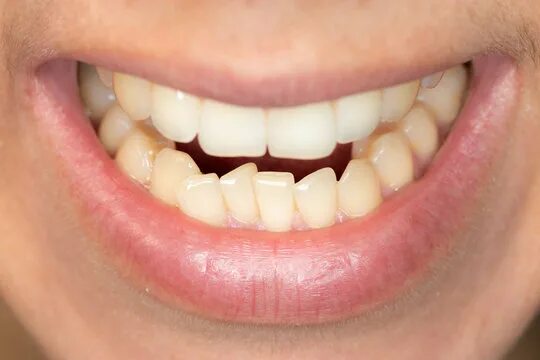 Нижний ряд зубов фото Malocclusion Зображення - огляд 6,118 Стокові фото, векторні зображення й відео 