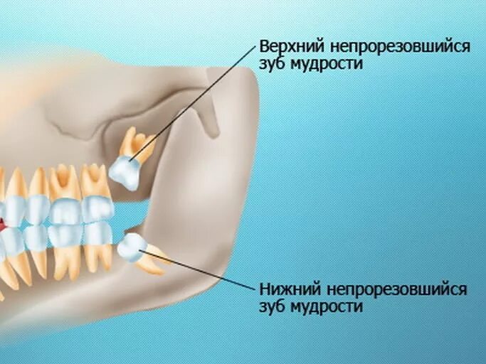 Нижний зуб мудрости удаление фото Зуб мудрости на картинке