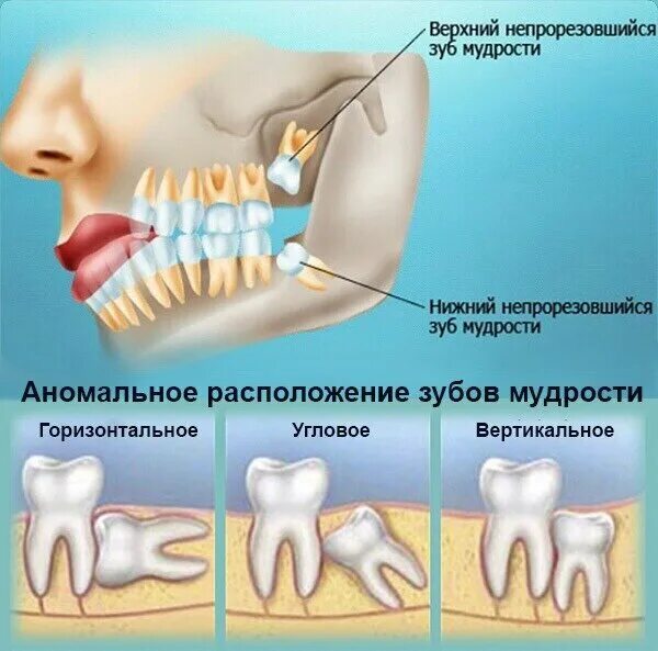 Нижний зуб мудрости удаление фото Что делать после удаления зуба мудрости? О здоровье простыми словами. Альфа-стом