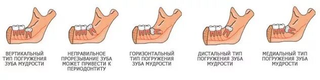 Нижний зуб мудрости удаление фото Удаление зуба мудрости в Москве - цена от 5000 рублей