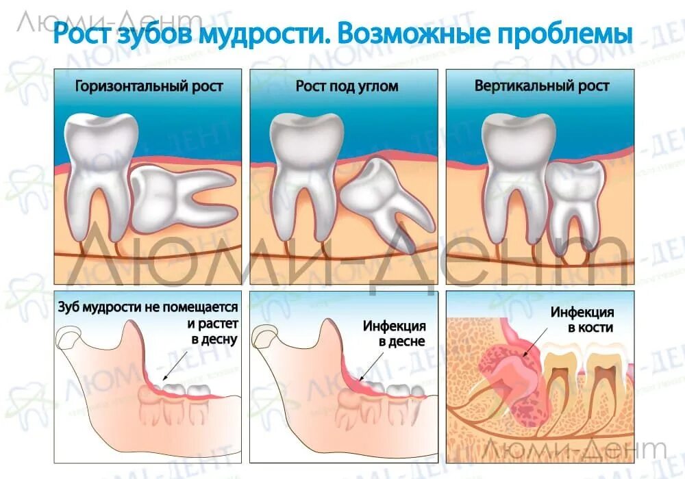 Нижний зуб мудрости удаление фото Зуб мудрости на схеме зубов