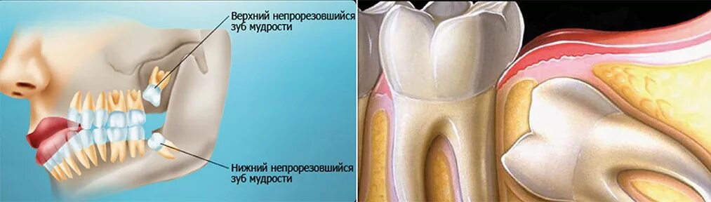 Нижний зуб мудрости удаление фото Удаление зуба мудрости - клиника Genesis