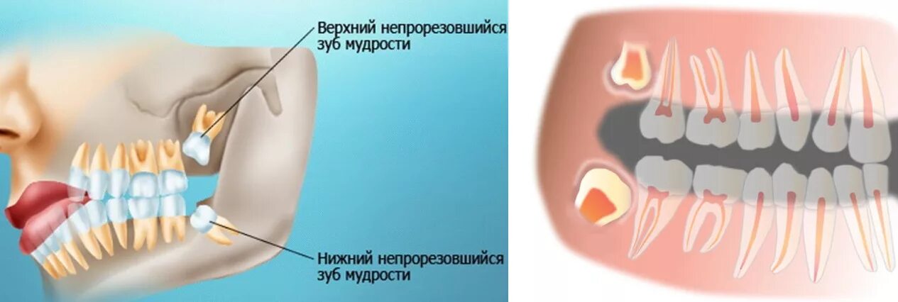 Нижний зуб мудрости удаление фото Удаление зубов мудрости от 6500 рублей - м. Октябрьская Отзывы, акции, фото до и