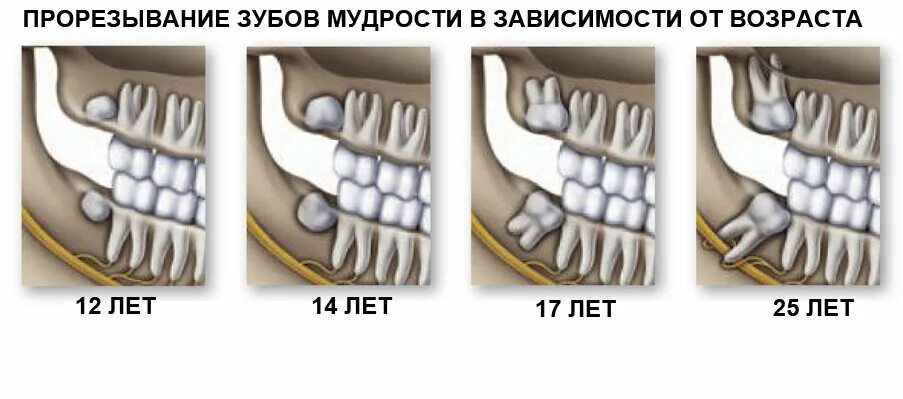 Нижний зуб мудрости удаление фото Безболезненное удаление зуба мудрости на аппарате "пьезотом" в Симферополе Лечен