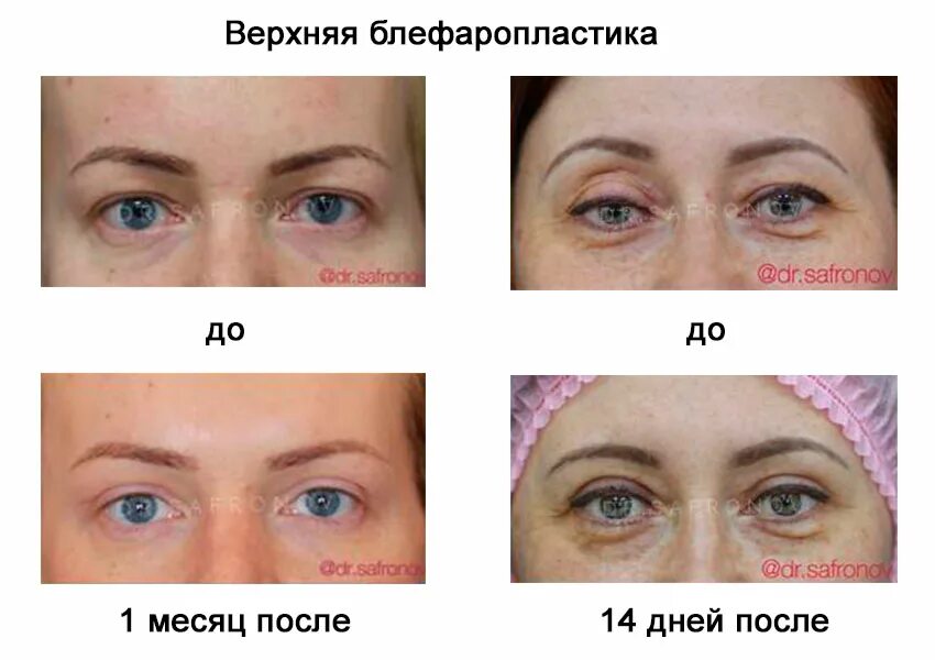 Нижняя блефаропластика фото до и после отзывы Можно после блефаропластики