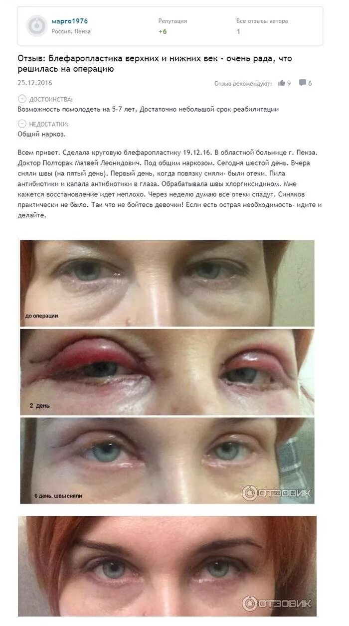 Нижняя блефаропластика фото по дням после операции Сколько восстанавливаться после блефаропластики - найдено 78 картинок