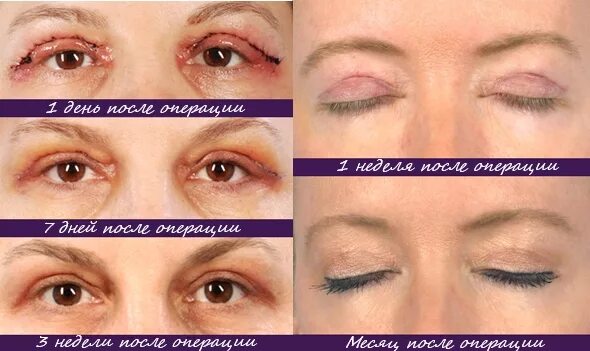 Нижняя блефаропластика фото по дням после операции Веки после блефаропластики по дням