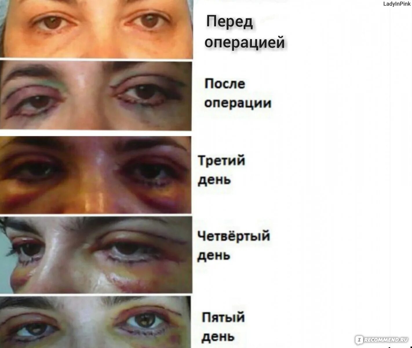 Нижняя блефаропластика фото по дням после операции Блефаропластика круговая - "Круговая блефаропластика, 50 лет, местный наркоз. Ощ