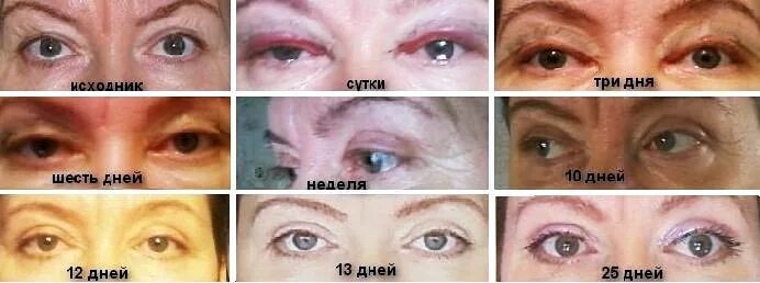 Нижняя блефаропластика отзывы фото Лазерная блефаропластика. Отзывы прооперированных нижних, верхних век, фото до и