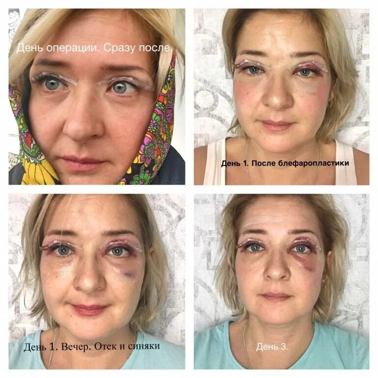 Нижняя блефаропластика отзывы фото Блефаропластика верхних, нижних век. Фото до и после процедуры