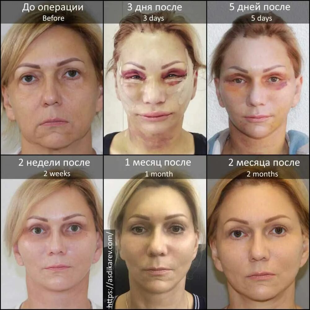 Нижняя блефаропластика отзывы фото Как проходит реабилитация после круговой подтяжки лица